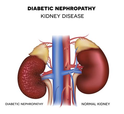 What Is Diabetes Nephropathy